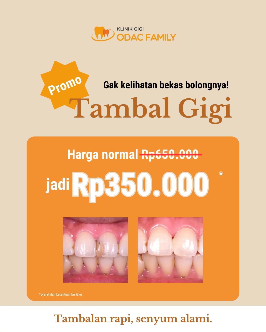 Gigi bolong? Jangan dibiarkan ya!